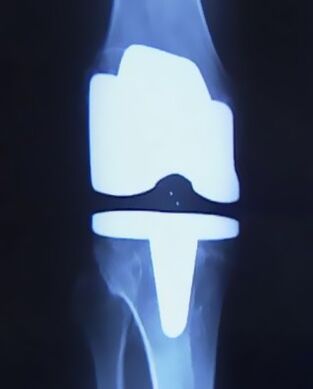 X-repay- ի նկարը `համատեղը փոխելու համար արհեստական ​​պրոթեզով արհեստական ​​պրոթեզով